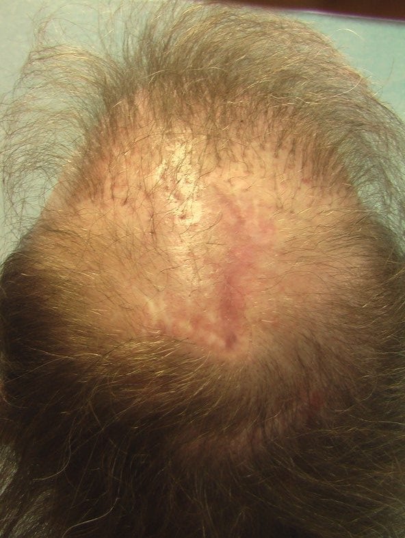 patient showing stretch back of his baldness reduction scar 