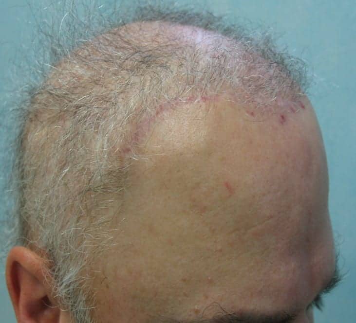 Side view of scarring left on the patient's temples and hairline resulting from his hair flap surgery.