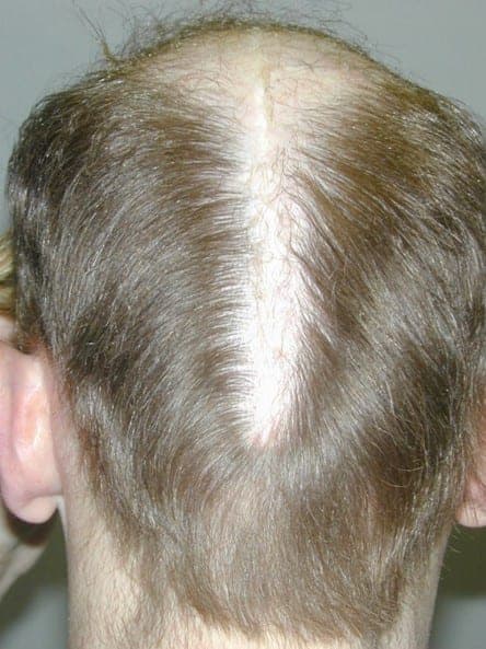 Patient with crown slot formation which forms as hair loss from male pattern baldness continues to progress around the edges of the scalp reduction excisions that were closed together. 