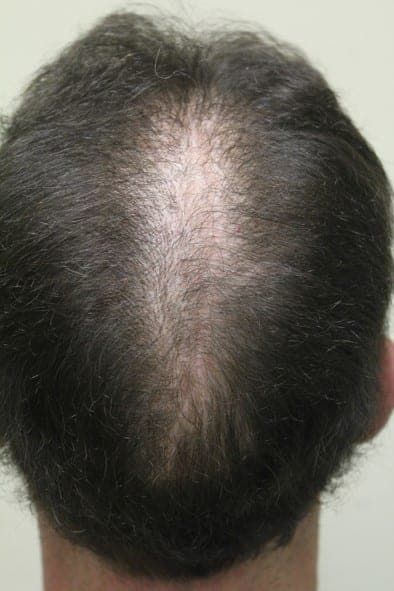Photo shows a vertical linear scar where the edges of the patient's scalp reduction procedure were closed. However, hair loss continued to progress around these edges creating a visible slot.