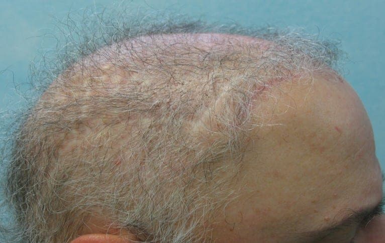 Hair flap surgery patient showing linear scarring in the front and side of the head 