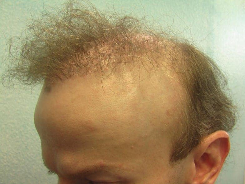This baldness reduction patient shows unusual angulation of the ears. This occurs from raising the periauricular areas once the edges of the scalp are closed together.