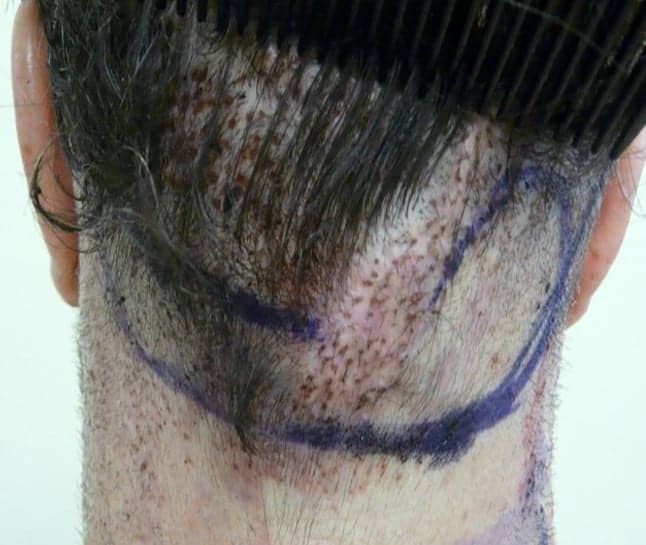 Patient photo showing a patient with raised nape and occipital areas resulting from his hair flap surgery procedure. 