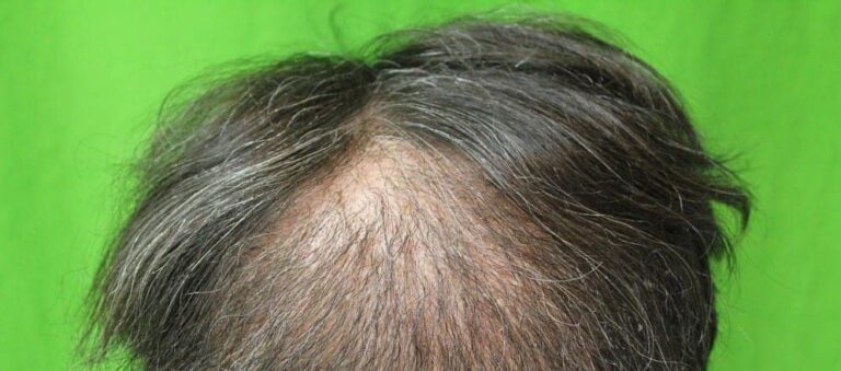 Back view of a hair flap surgery patient showing hair pointing backwards, instead of the forward pattern of growth found in nature. 