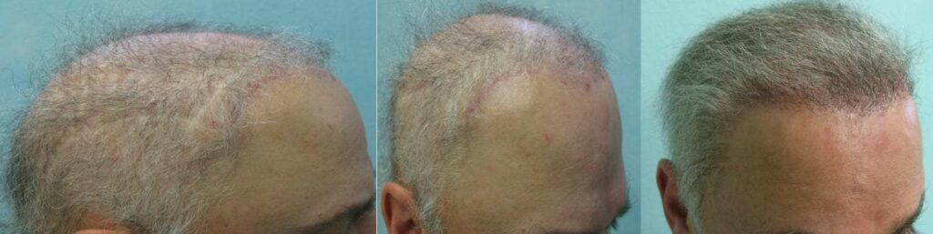 Repair For Hair Flap Surgery - Body Hair Transplant Grafts