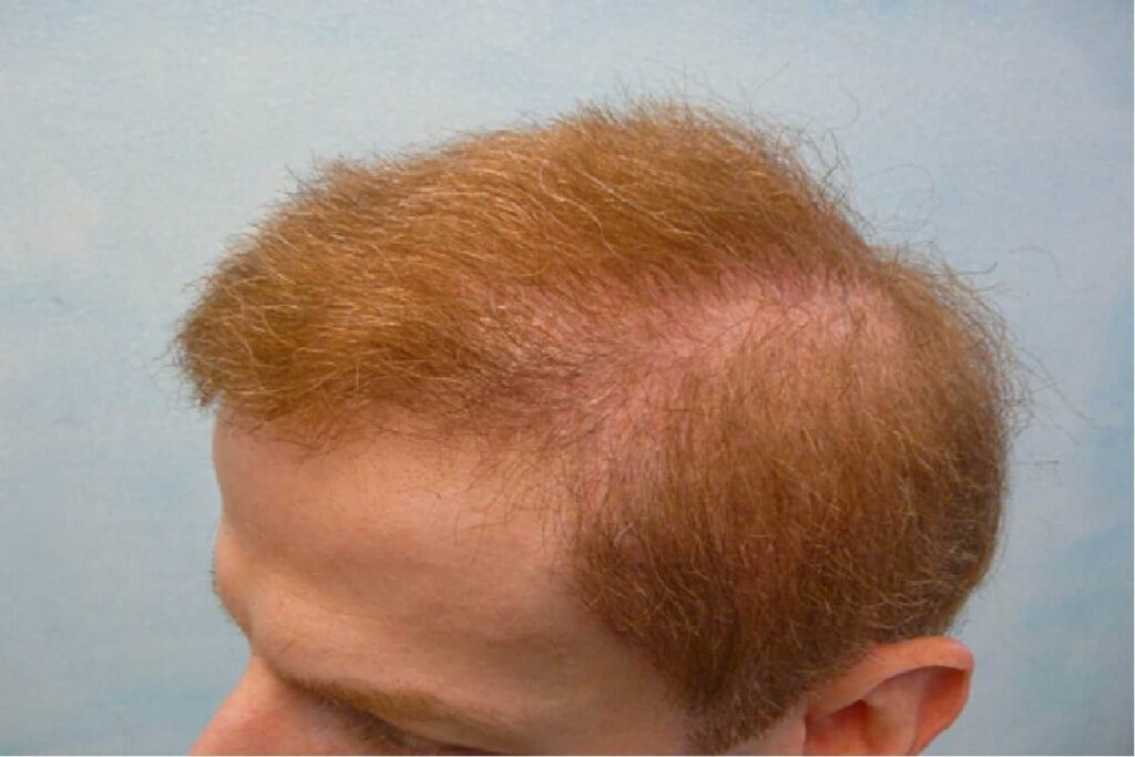 The patient was pleased with the results of his temple hair transplant. The advanced FUE Dr.UPunch Rotor™ was able to extract thousands of grafts from the patient's beard and chest donor areas, providing the patient with the grafts needed to produce the best results. The patient was pleased with the results of his temple hair transplant. The advanced FUE Dr.UPunch Rotor™ was able to extract thousands of grafts from the patient's beard and chest donor areas, providing the patient with the grafts needed to produce the best results.