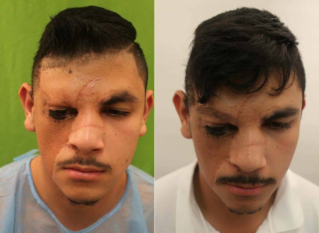 Congenital nevus patient before and after his eyebrow construction surgery with leg hair