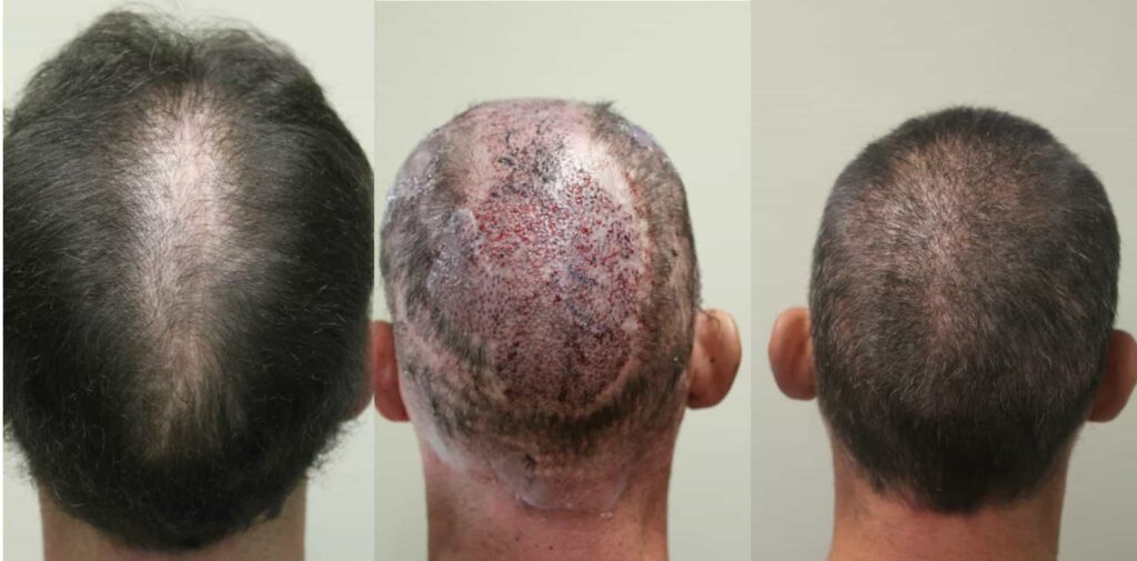 Scalp reduction repair of crown slot formation and distorted hair growth patterns using Dr.UPunch intelligent ™ 