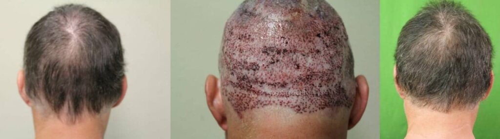 Repair of elevated neckline resulting from alopecia reduction surgery using head and body hair harvested with the Dr.UPunch intelligent ™ punch to restore a more natural looking posterior hairline on the back of patient's head