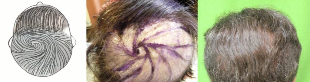Hair flap surgery repair of abnormal hair growth direction and crown baldness