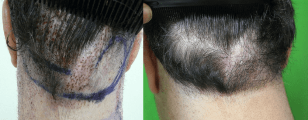 Before and after photos showing hair flap surgery repair of raised nape and occipital areas of the scalp