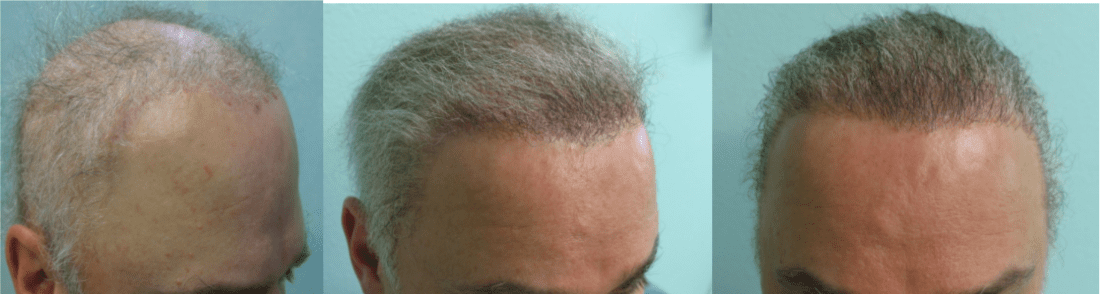 Repair of a type of hair flap surgery deformity that resembles the forehead of Frankenstein. Dr. Umar achieved a more normal looking hairline through the use of body hair grafts since the patient's scalp hair had largely been depleted