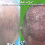 Top of patient's head before and after his Norwood 6 FUE using BHT*