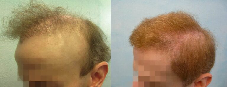 Side view of patient's alopecia reduction repair results using body hair grafts harvested by Dr.UPunch intelligent ™ and transplanted to recreate a more normal looking coverage, through the head and fill in the raised periauricular area