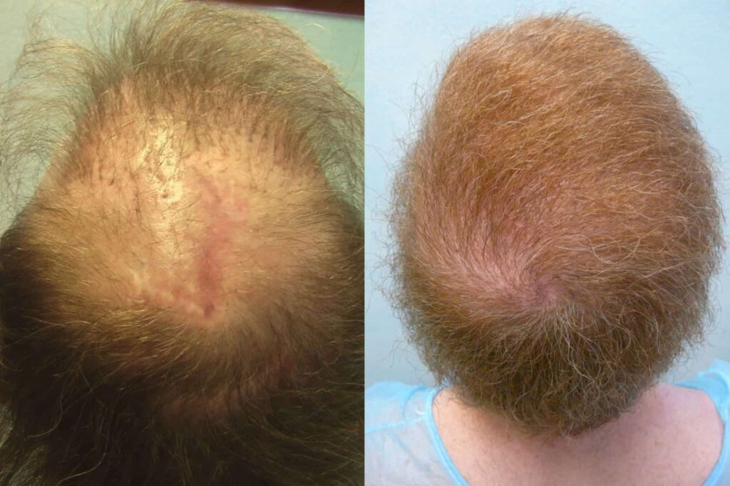 Using the Dr.UPunch intelligent ™ punch, Dr. Umar was able to expand the patient's donor supply beyond the scalp to cover the stretch back effect and dog eared scar resulting from scalp reduction surgery