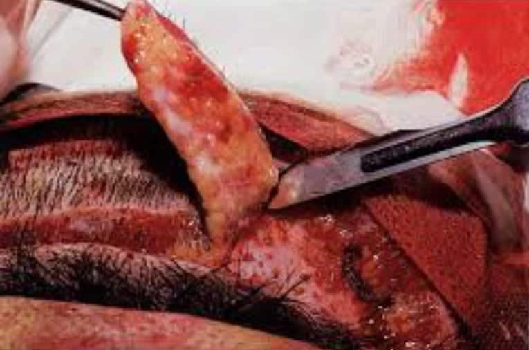 Removal of strip from the safe donor zone on the back of the patient's head during Follicular Unit Strip Surgery (FUSS), also known as FUT (Follicular Unit Transfer) or FUHT (Follicular Unit Hair Transplant)