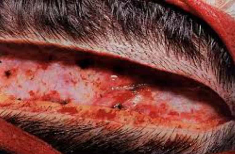 Photo showing the open wound that remains after the removal of the strip, during an FUSS procedure. 