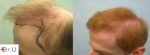 Temple Reconstruction For Hair Transplant Repair Patient
