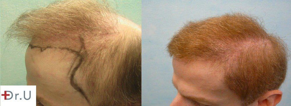 Hair transplant repair who required hair restoration for the temples to complete a normal looking outcome