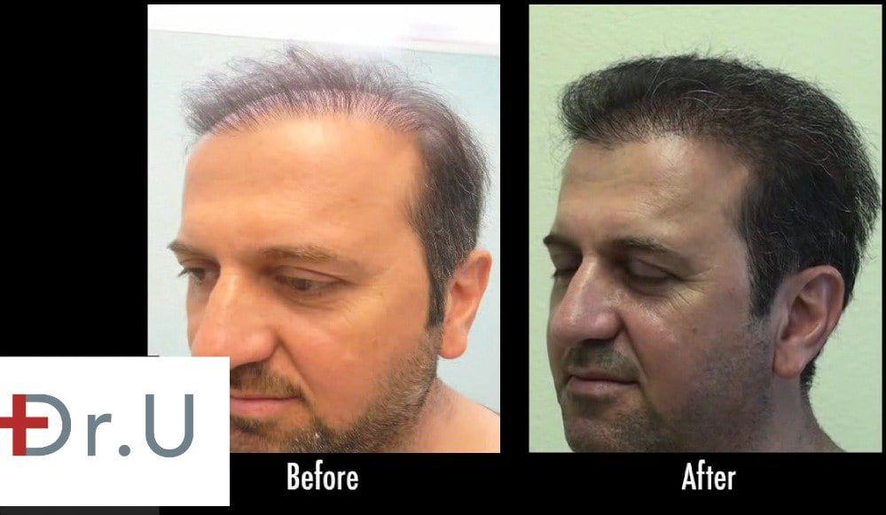 Hair restoration for the temples is necessary for completing the look of a well crafted hairline