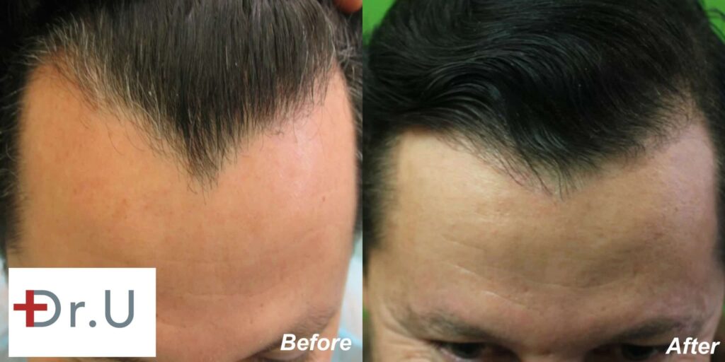 Dr. U extracted nape hair for this patient's hairline reconstruction to soften the harsh angular lines for a more youthful look.* Dr. U extracted nape hair for this patient's hairline reconstruction in order to soften the harsh angular lines for a more youthful look.