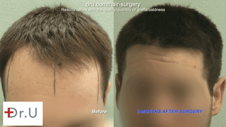 Dr. U constructed an aggressive, natural looking hairline for this patient which reduced the size of his forehead. 3,200 grafts were extracted from the nape in this FUE hairline restoration