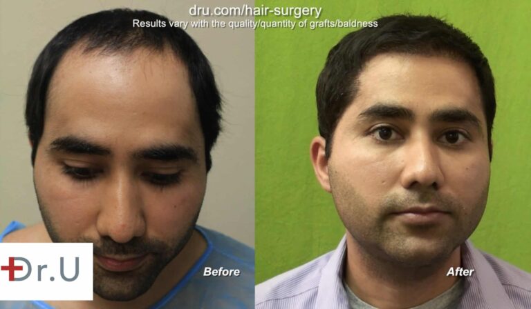 Dr. U constructed a soft, natural looking hairline for this patient using 6,000 grafts from the head and beard. The results of the FUE hairline restoration are shown 2 years after surgery