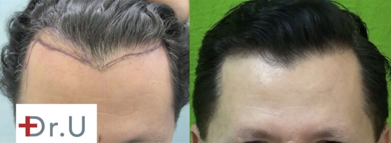 Unhappy with his unusual hairline recession, this patient approached Dr. U for an FUE hairline restoration that would eliminate the sharpness of the "M" shaped hairline.