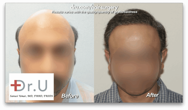 This patient experiencing severe baldness wanted a mature natural looking hairline, in addition to coverage on his top and crown. Using his Dr. UPunch Rotor to augment the patient's donor supply, Dr. U was able to extract 8,000 grafts from the patient's head and 4,000 from his beard over the course of 2 surgeries, 1 year apart.