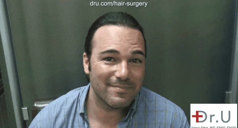 Beverly Hills patient shown two year after his hairline reconstruction using leg hair