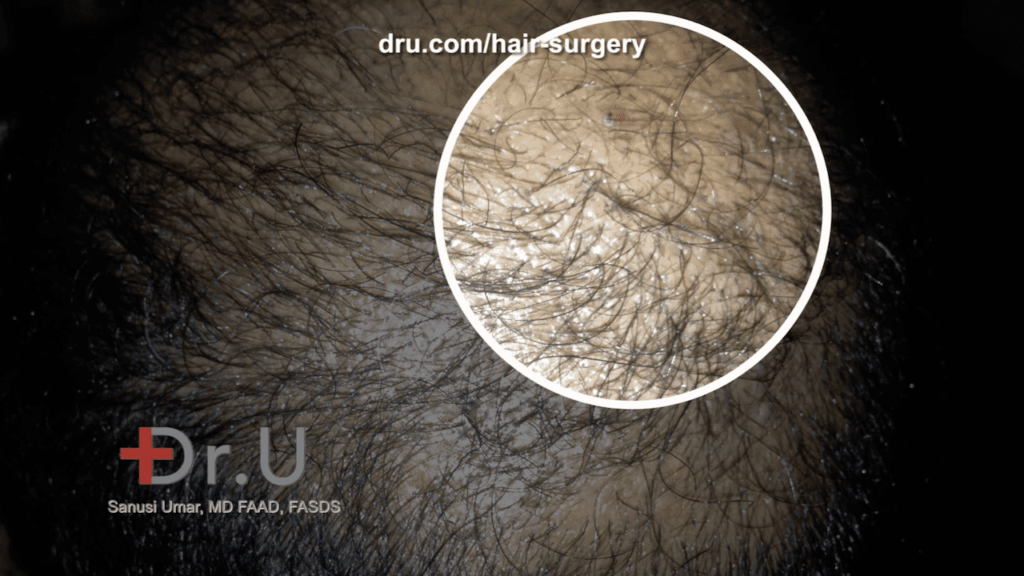 It is not uncommon to see pimples after a hair transplant. Keep your doctor appraised of their development and heed their advice.