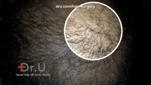 It is not uncommon to see pimples after a hair transplant. Keep your doctor appraised of their development and heed their advice.