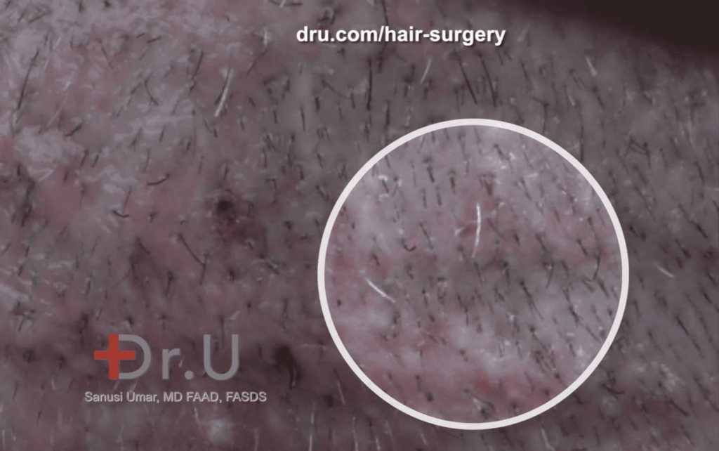 Hair transplant pimples are not unexpected after a hair restoration procedure. It is important to refrain from DIY treatments to get rid of acne after hair transplants. Instead, schedule a consultation with your physician. 