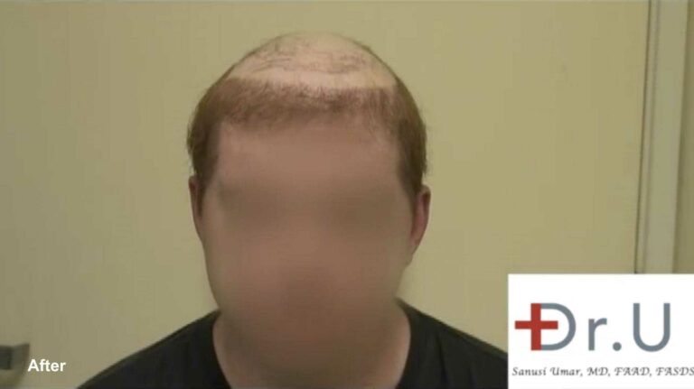 Since his traditional donor area was depleted due to previous surgeries at other clinics, Dr. U extracted grafts from the chest, stomach, and beard. By using body hair, Dr. U was able to provide the patient with a natural looking hairline to be integrated with the patient's hair piece. 