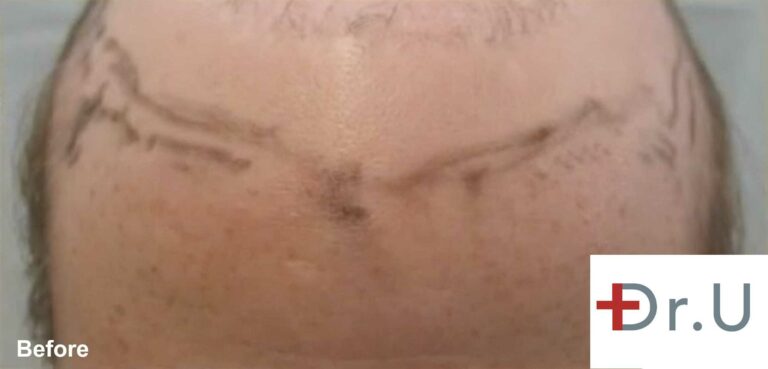 This patient came to Dr. U with extensive scarring, a depleted head donor area, and advanced baldness. The patient wanted to be able to use his hair piece without it looking obvious, but his absent hairline and receded temple points made that difficult. Dr U proceeded to perform an FUE hairline restoration in order to enable the use of the patient's hair system.