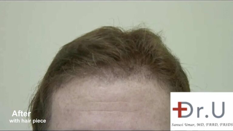 Using his advanced FUE UGraft system, Dr. U created temple points to be more in line with the patient's hair piece, creating a smooth integration between a natural looking hairline and toupee.