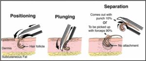 The Dr.UPunch Curl can follow the curvature of the hair follicles that are found in black patients. 