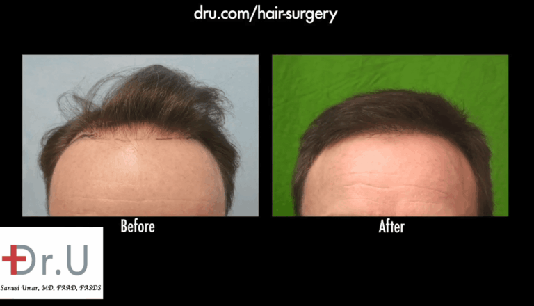 12 months after his FUE hairline restoration, the patient is extremely satisfied with his mature, neutral hairline.