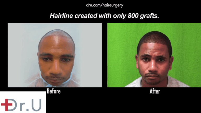 FUE hair transplantation for African Americans can produce amazing coverage if the grafts are safely and successfully harvested. Advanced tools like the Dr.UPunch Curl ™ allow this type of reliable growth to become possible