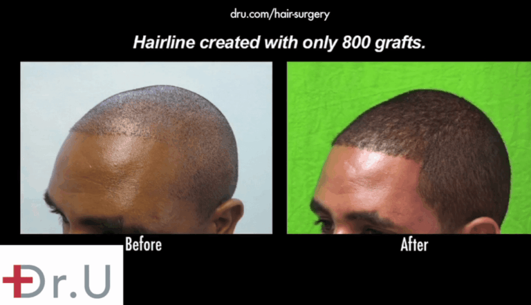 Receding hairlines in black men can be reversed using grafts that are successfully harvested using specialized extraction tools like the Dr.UPunch Curl ™ *