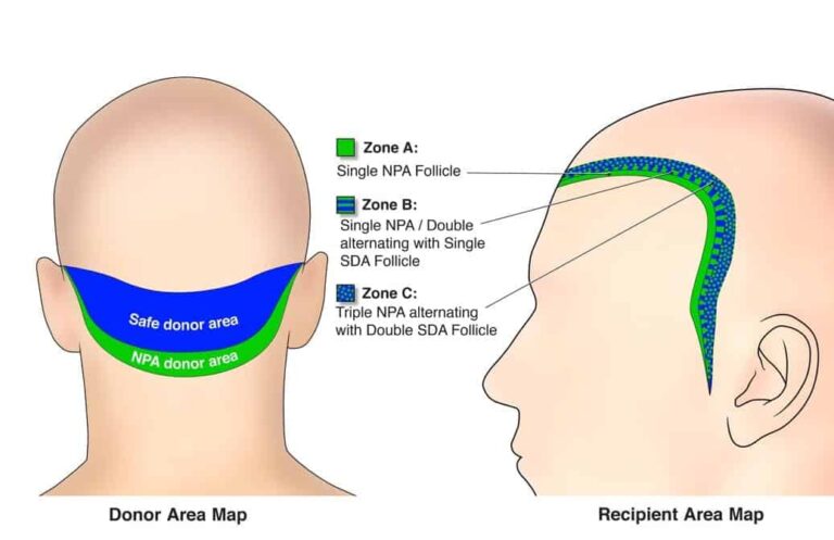 To recreate hairlines and temples in a celebrity or other individual, softer nape hair can be inserted to recreate a naturally soft looking edge