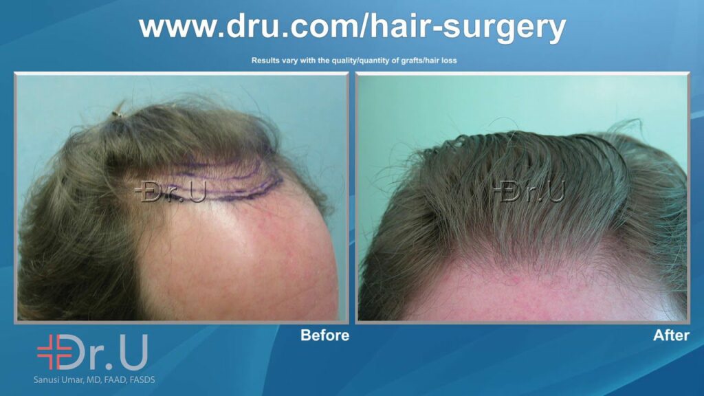 On the left, the planning degree of hairline advancement is shown. Dr U's Subtle hair transplant was used to achieve his goal of remaining a Norwood 3 but with a fuller look as seen on the right*