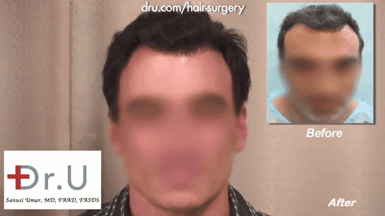 After previous strip surgeries resulted in unwanted attention to his toupee-like hairline, the patient came to Dr. U for a hairline correction. Using his Dr. UPunch Rotor to safely extract 3,000 grafts from the head and nape, Dr. U was able to construct a more natural looking hairline with softer temple points.
