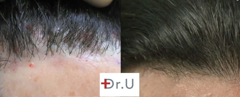 Patient's hairline reconstruction using leg hair produced more natural looking hairline restoration results, as shown in these before and after photos
