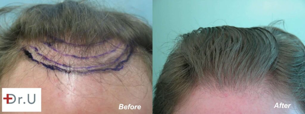 Nape hair was used to create a softer, natural looking hairline and temple points for this patient. Nape hair was used to create a softer, natural looking hairline and temple points for this patient.