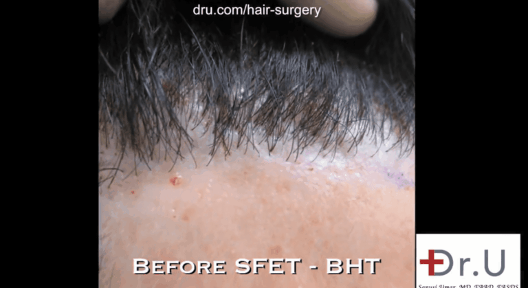 Patient before his procedure with Dr. Umar to reverse poor hairline restoration results. Hairline shows obvious looking plugs due to the use of large sized punches