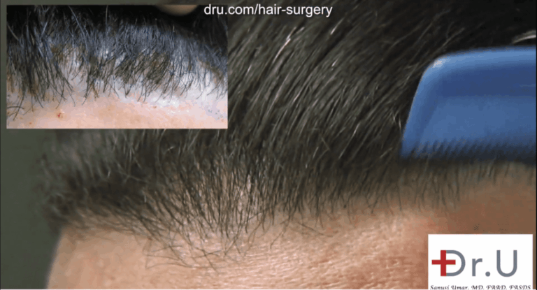 Before and after photos showing a successful outcome to correct the patient's pluggy hairline using leg hair