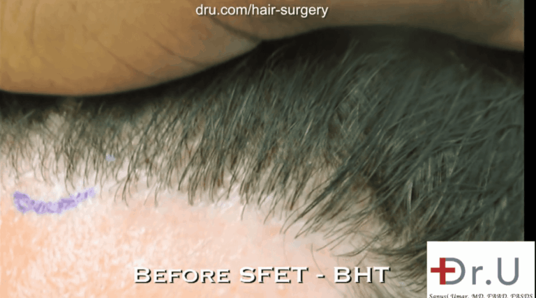 Dr. Umar recommended a hairline reconstruction using leg hair to correct the unnatural looking clustering of hair 