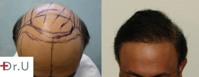 This severely bald, Norwood 7 patient was able to achieve comprehensive coverage for both the hairline and the crown due to the use of body hair grafts harvested with the Dr.UPunch intelligent This severely bald, Norwood 7 patient was able to achieve comprehensive coverage for both the hairline and the crown due to the use of body hair grafts harvested with the Dr.UPunch intelligent