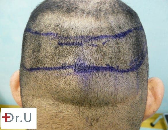 In this patient's case, a line of demarcation can be seen between the SDA and the nape, which means that nape hairs would not survive long-term in an FUE hairline surgery. A line of demarcation can be seen between the SDA and the nape, which means that nape hairs would not survive long term in an FUE hairline surgery in this patient's case.
